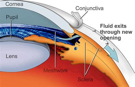 cpt code for trabeculectomy with mitomycin c|Trabeculectomy Billing Guide For Glaucoma Surgery